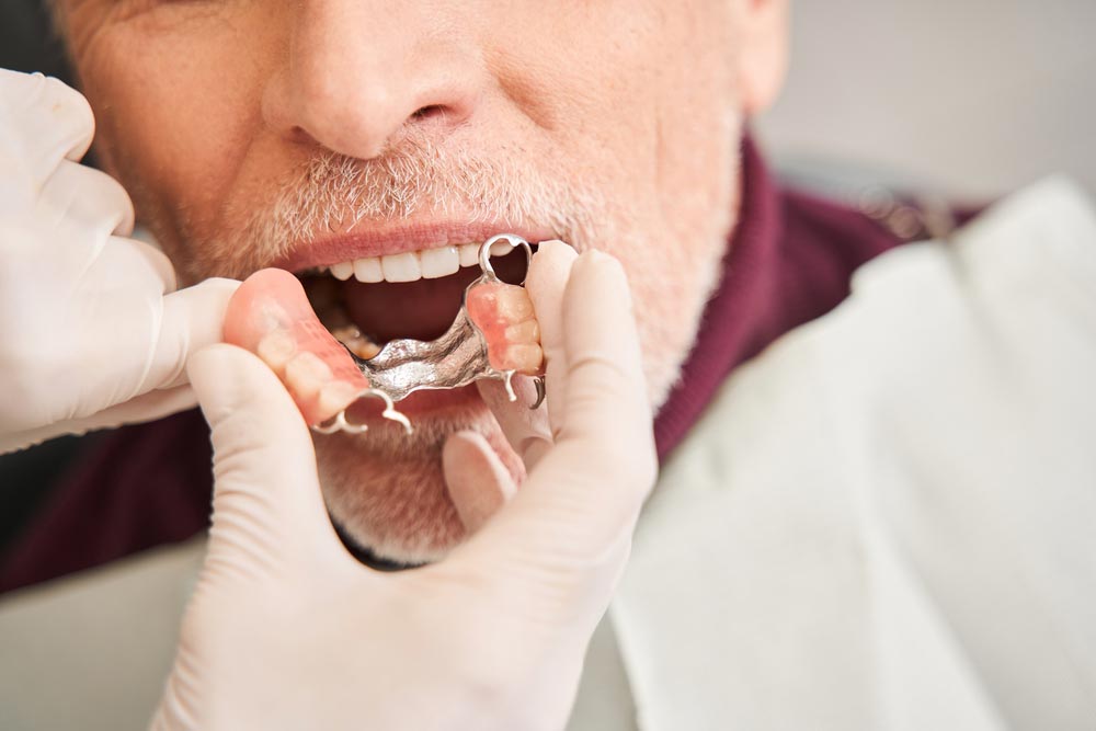 Fitting Partial Dentures